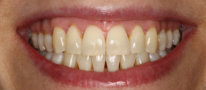 Invisalign Patient Photos