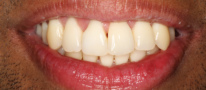 Invisalign Patient Photos